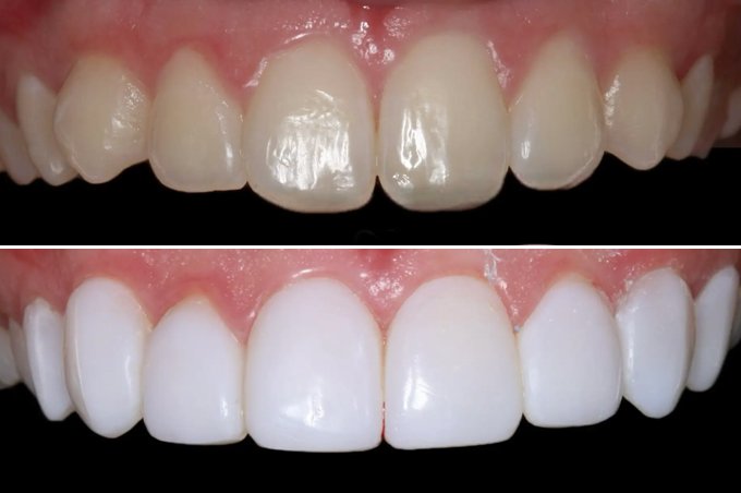 composite bonding hawick