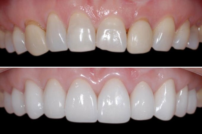 composite bonding
