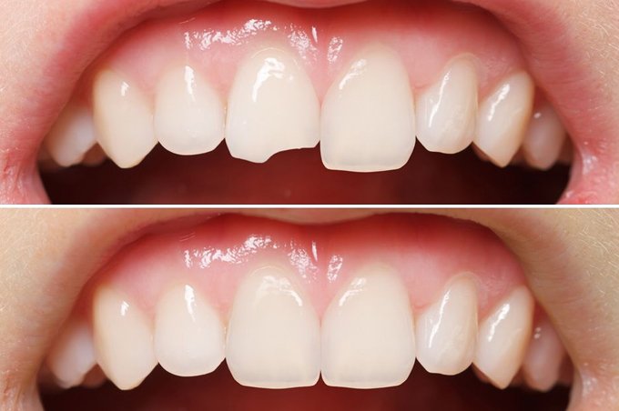 composite bonding