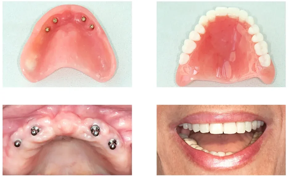 full mouth dental implant hawick