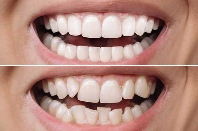 Invisalign Dentist in Hawick