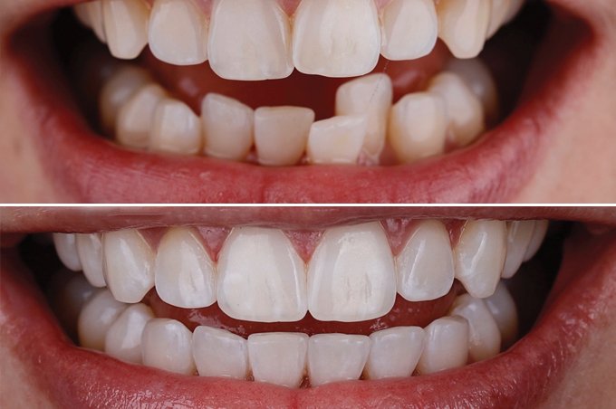 best Invisalign Dentist in Hawick