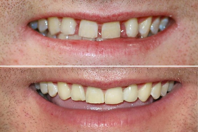 best Invisalign Dentist in Hawick