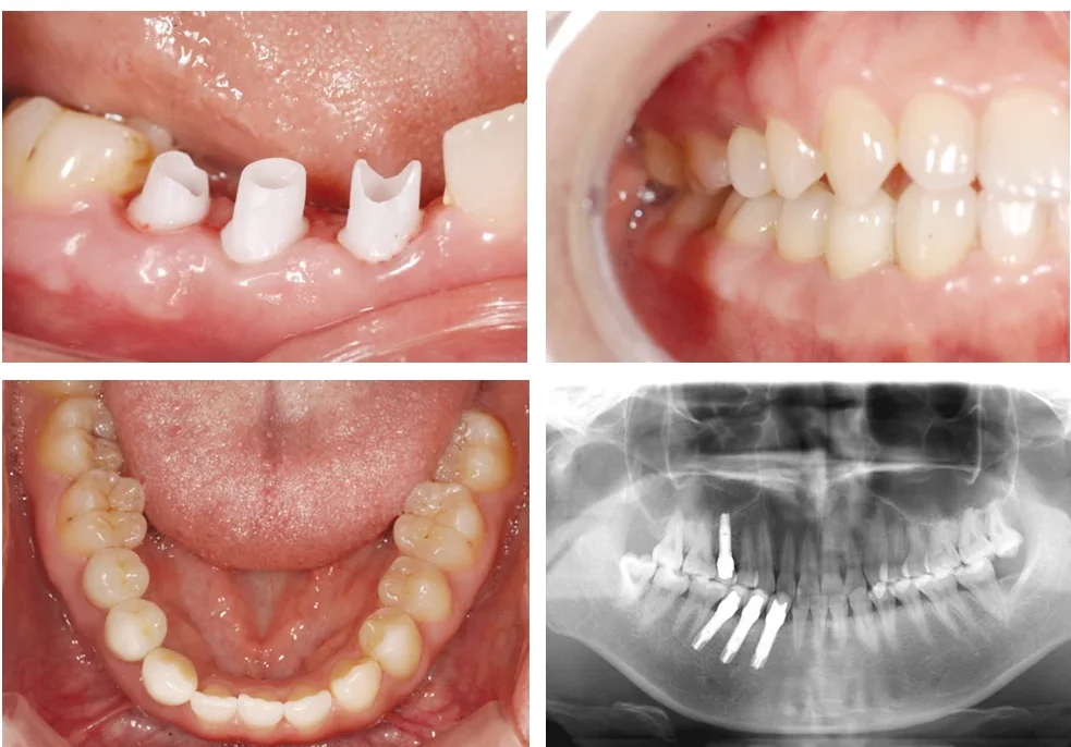 multiple dental implant hawick