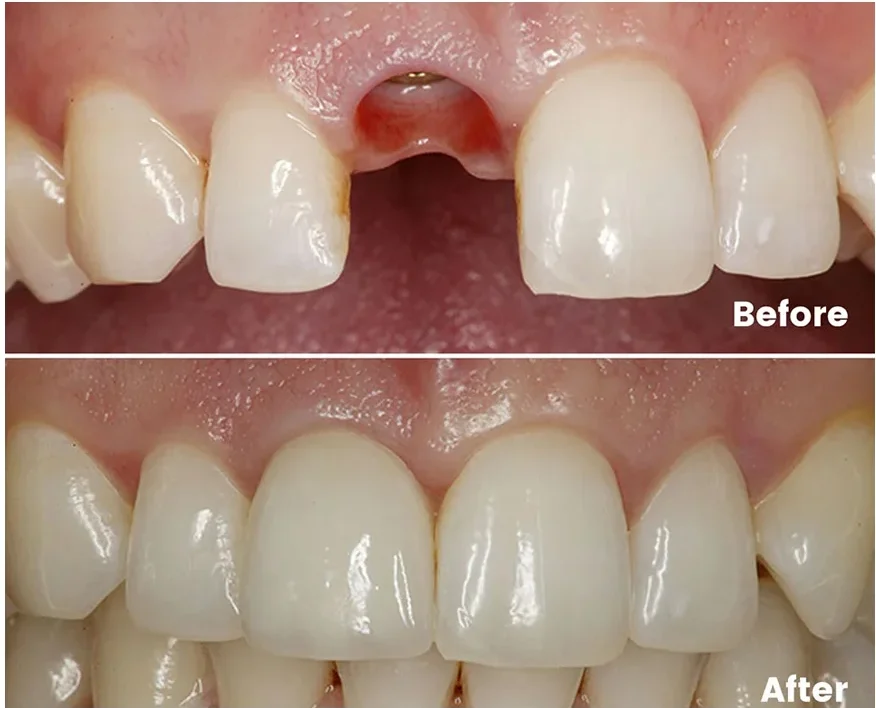 single dental implant hawick