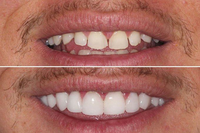 COMPOSITE VENEERS BEFORE AND AFTER