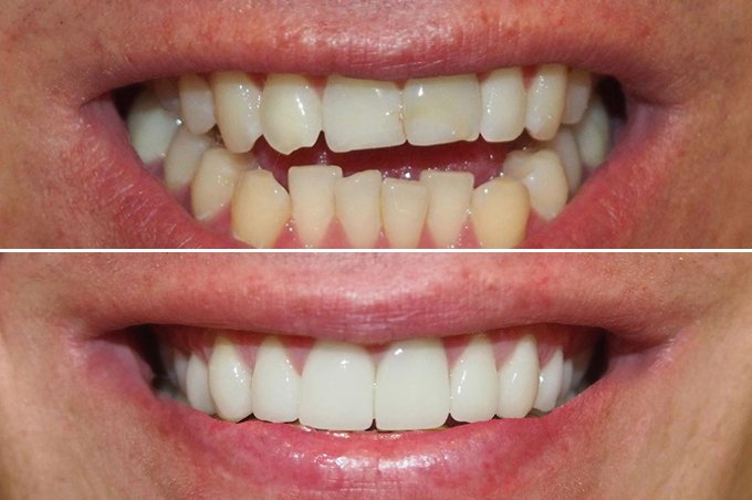 COMPOSITE VENEERS BEFORE AND AFTER