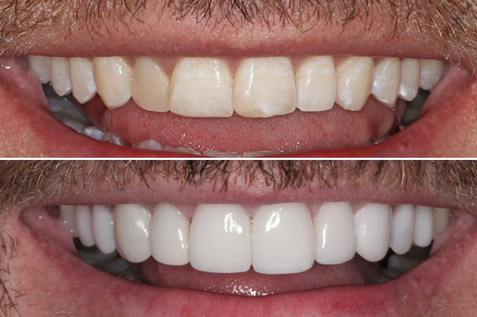 COMPOSITE VENEERS BEFORE AND AFTER